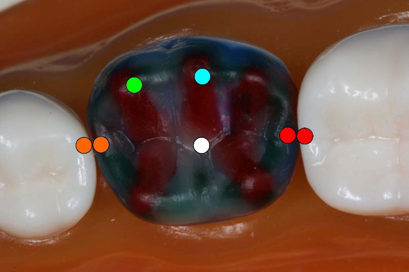 Md1stMolarContacts.jpg