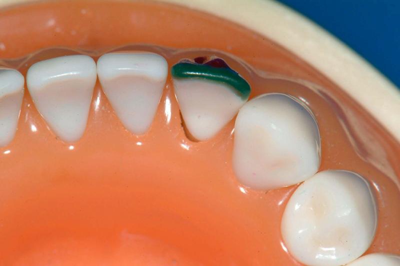 MdLateralStep3Incisal.jpg