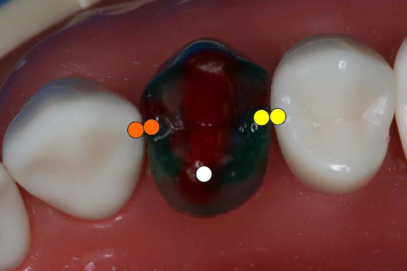 Mx1stPremolarContacts.jpg