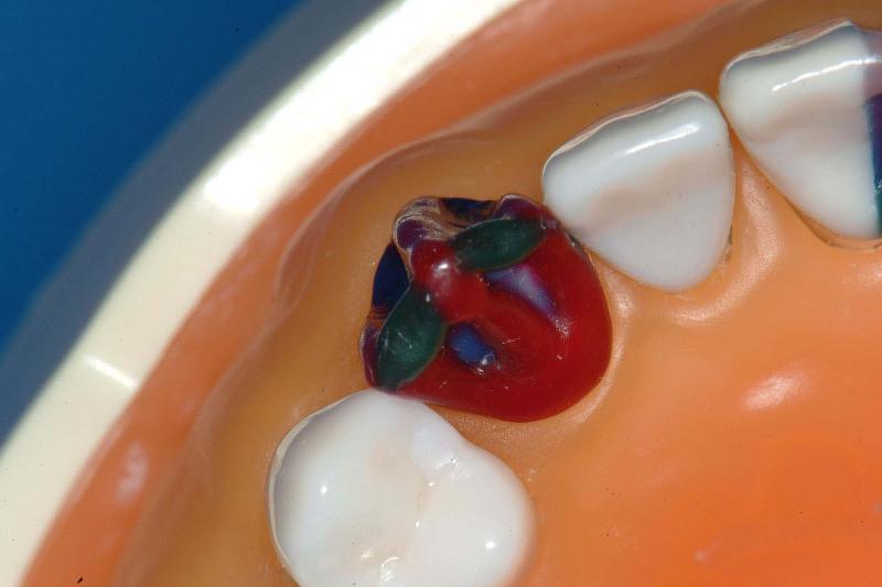 MxCanineStep4Incisal.jpg