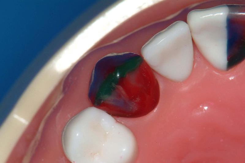 MxCanineStep5Incisal.jpg