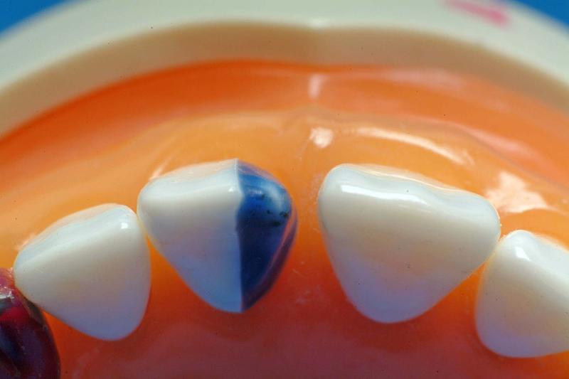 MxCentralStep1Incisal.jpg