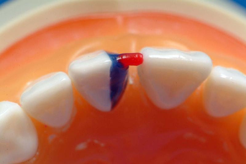 MxCentralStep2Incisal.jpg