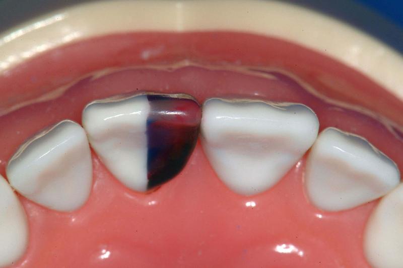 MxCentralStep5Incisal.jpg